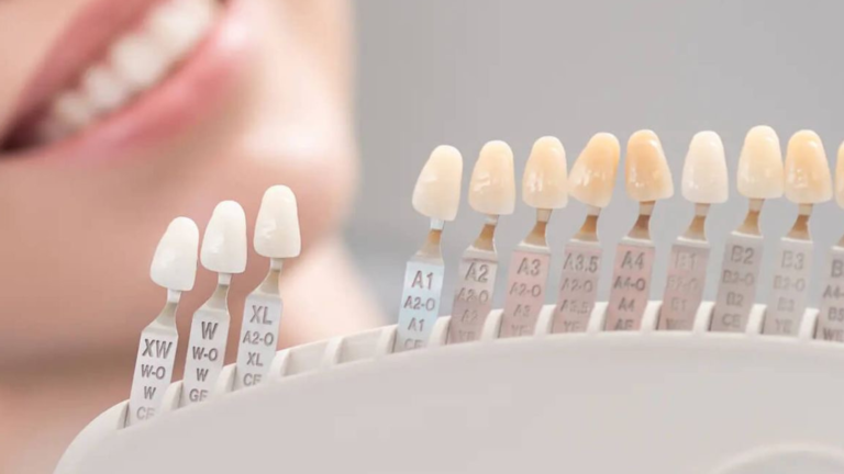 Estetică dentară profesională – ghid de culori pentru fațete dentare