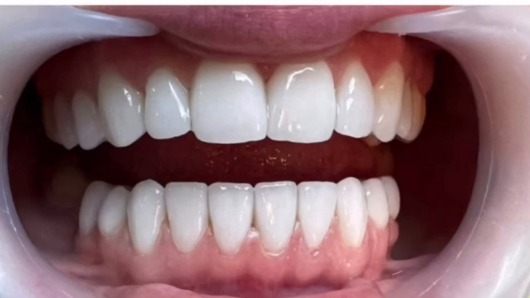 Rezultat estetic dentar cu fațete ceramice realizate la Dent Art Clinic